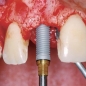 Implanturi dentare de la 200 de euro