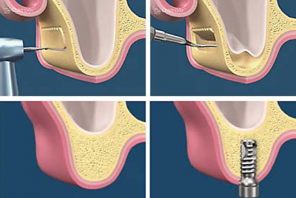 Tehnici inovative în implantologie: A-PRF - operația de sinus lifting