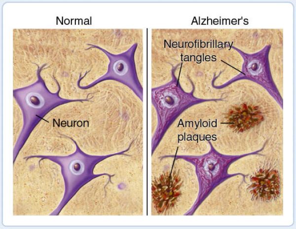 Maladia Alzheimer ar putea fi diagnosticata printr-un simplu control oftalmologic